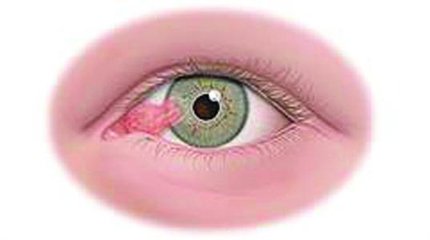 眼睛上會有一塊肉，影響視力怎么辦？