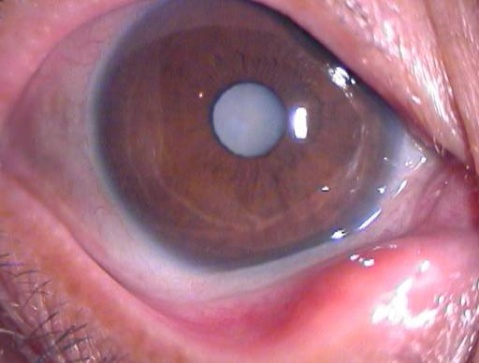 個別老人做完白內(nèi)障手術(shù)后不久會看不清