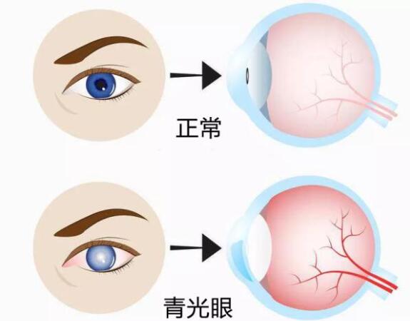 第17個(gè)青光眼周｜共管慢病青光眼，留得光明恒久遠(yuǎn)